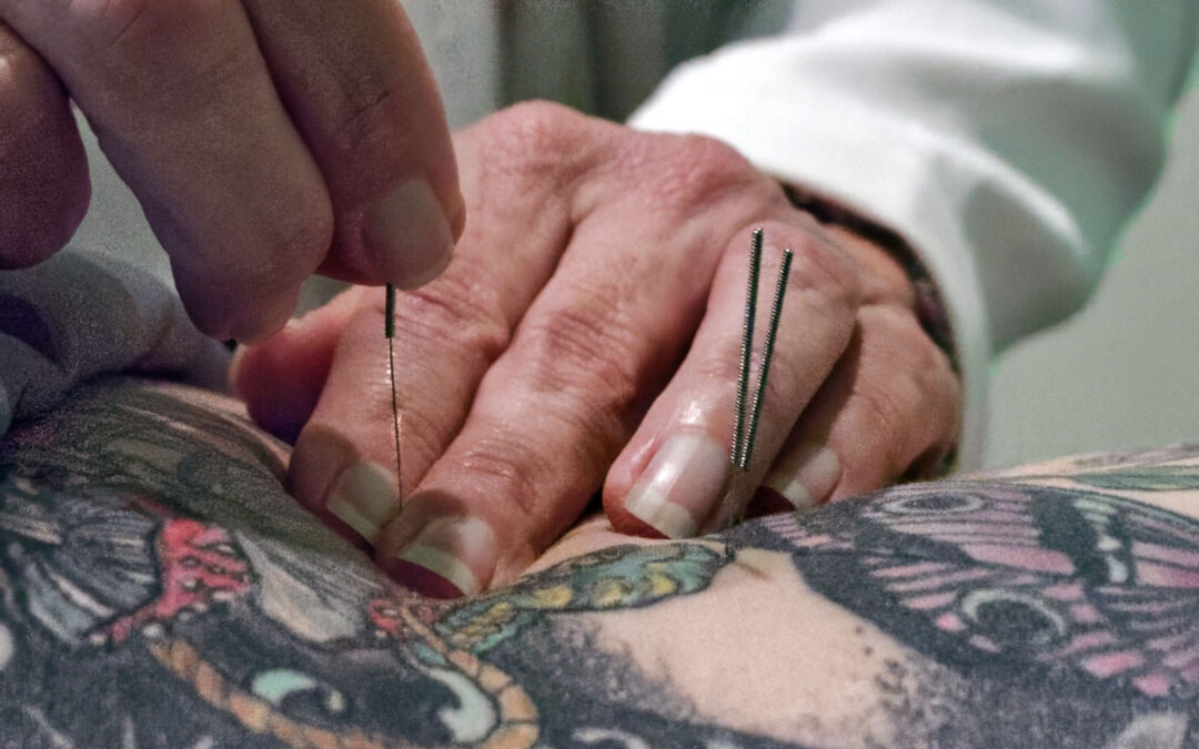 The Benefits of Acupuncture for Stress Relief and Overall Well-Being