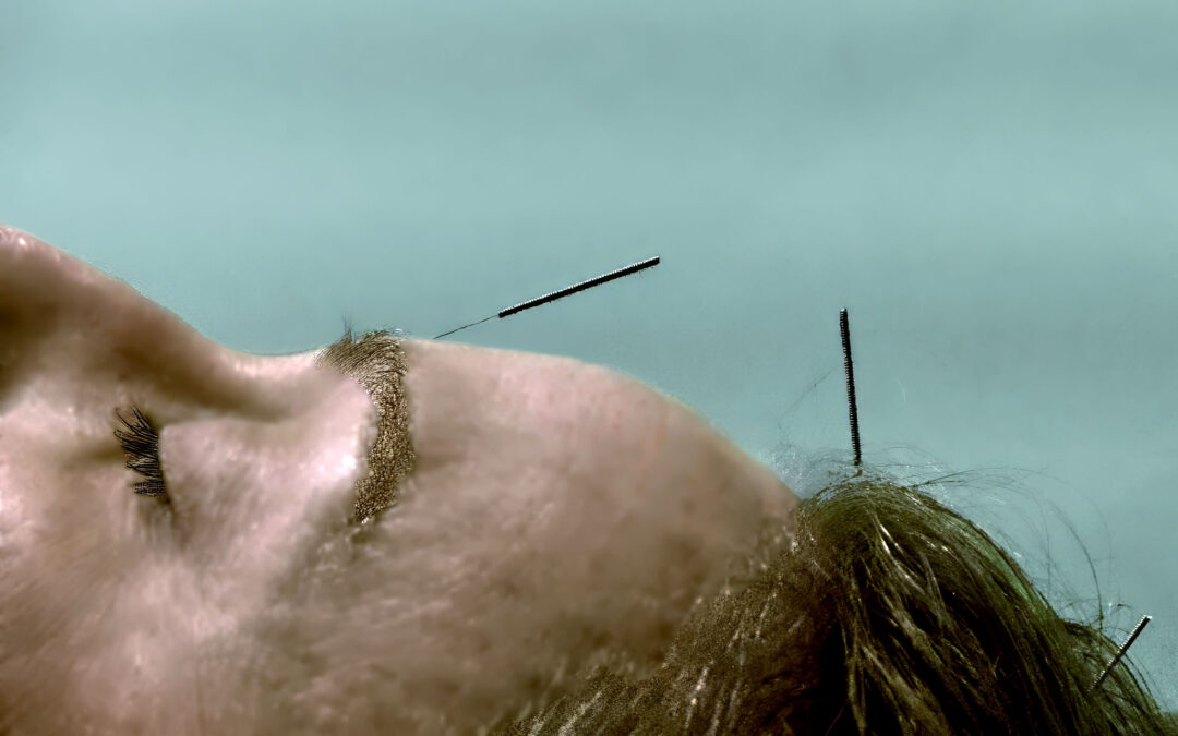 Acupuncture and Mental Health: Managing Anxiety and Depression Naturally