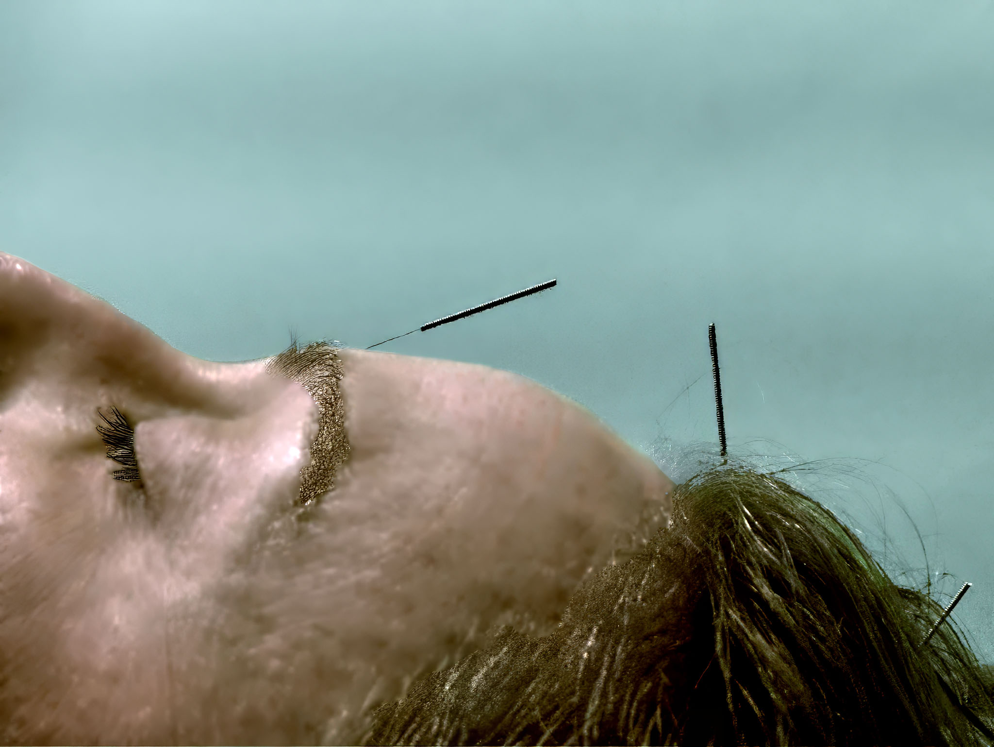 acupuncture for anxiety