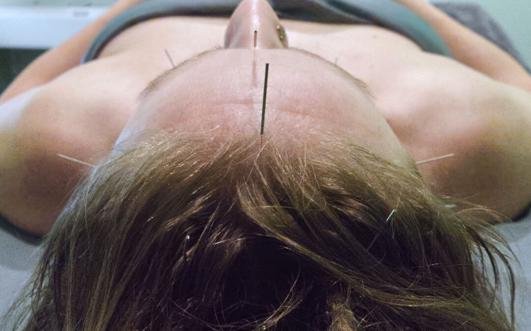 How Acupuncture Can Improve Sleep Quality