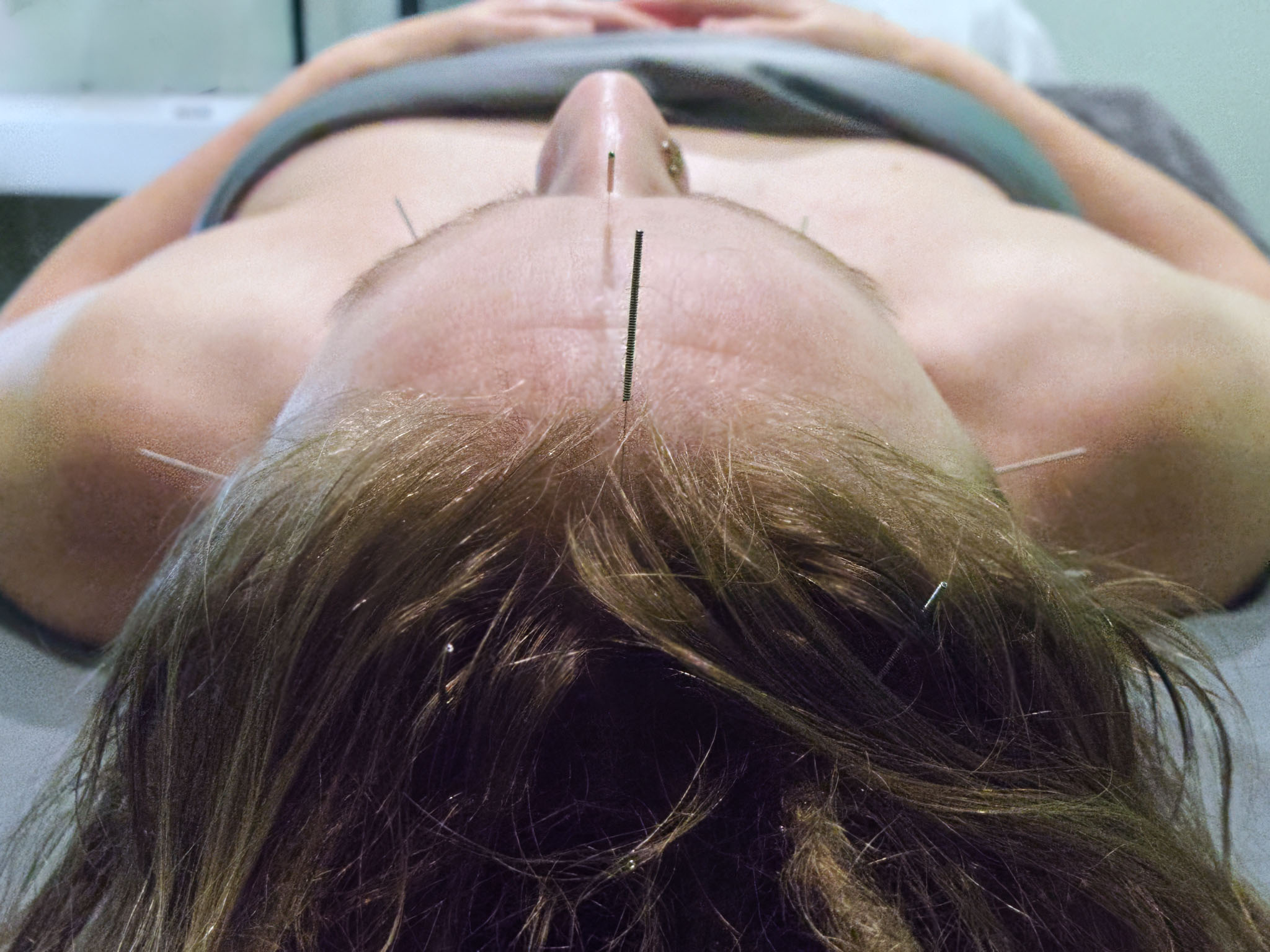 acupuncture for sleep