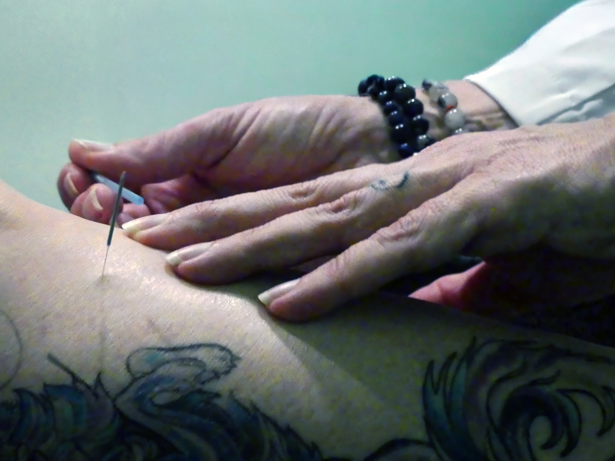 acupuncture treatment plan